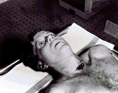 JFK autopsy photo